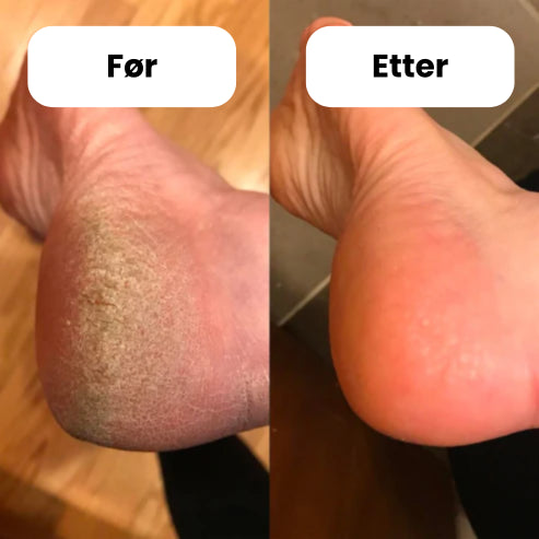 FeetCARE PRO™ | Tar bort hård hud snabbt och effektivt 