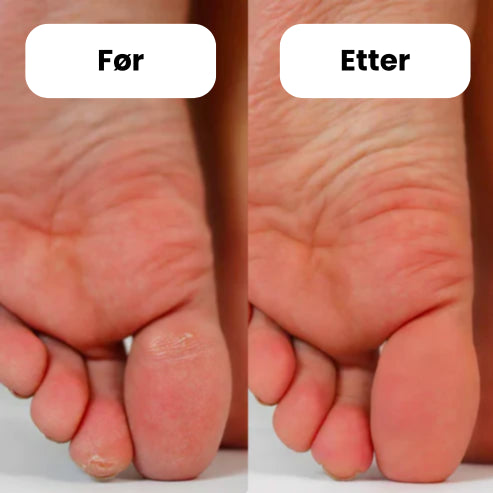 FeetCARE PRO™ | Fjerner Hard Hud Raskt & Effektivt - NordKlover